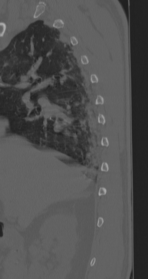 Chance fracture (Radiopaedia 33854-35020 Sagittal bone window 76).png