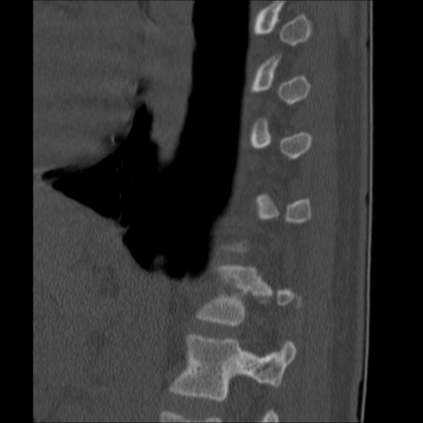 Chance fracture (Radiopaedia 36521-38081 Sagittal bone window 55).jpg