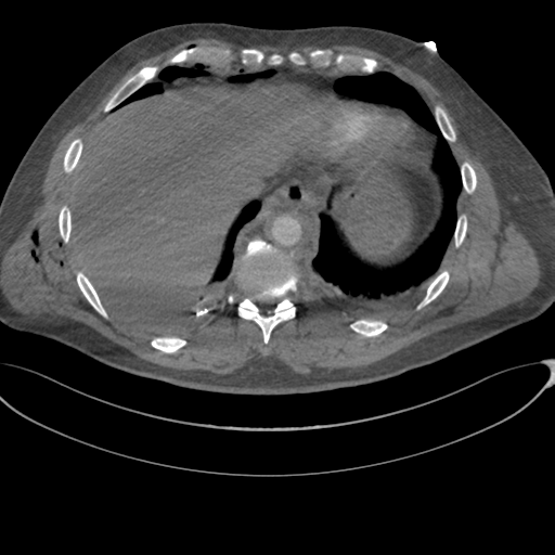 File:Chest multitrauma - aortic injury (Radiopaedia 34708-36147 A 241).png