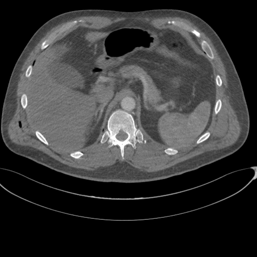 File:Chest multitrauma - aortic injury (Radiopaedia 34708-36147 A 293).png
