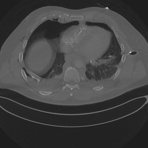 Chest multitrauma - aortic injury (Radiopaedia 34708-36147 Axial bone window 204).png