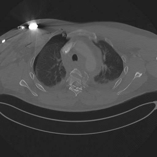 File:Chest multitrauma - aortic injury (Radiopaedia 34708-36147 Axial bone window 91).png