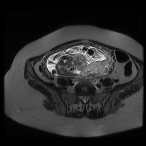 Chiari II malformation - fetal MRI (Radiopaedia 68099-77581 Axial T2-SSFSE 33).jpg