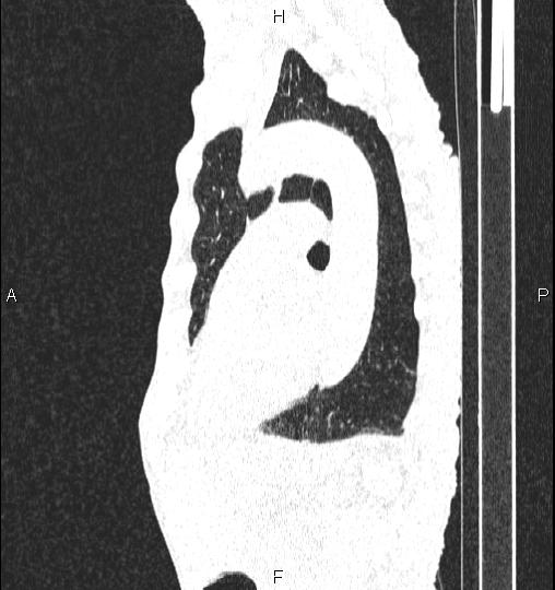 File:Chilaiditi sign (Radiopaedia 88839-105611 Sagittal lung window 60).jpg