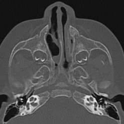 Choanal atresia (Radiopaedia 88525-105975 Axial bone window 30).jpg