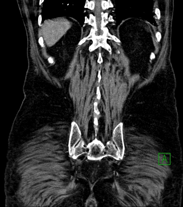 Cholangiocarcinoma with cerebral metastases (Radiopaedia 83519-98629 E 73).jpg