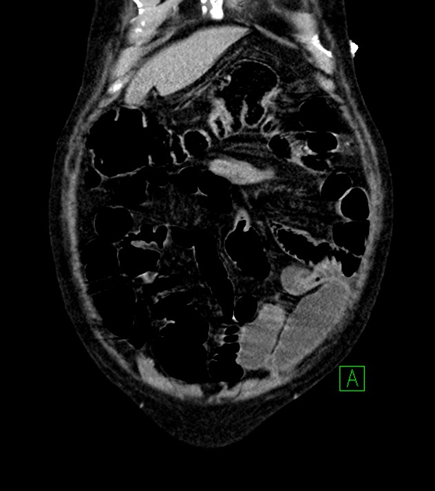 Cholangiocarcinoma with cerebral metastases (Radiopaedia 83519-98629 G 14).jpg