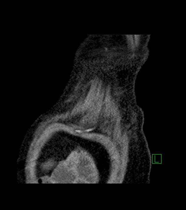 Cholangiocarcinoma with cerebral metastases (Radiopaedia 83519-98629 Sagittal C+ delayed 6).jpg