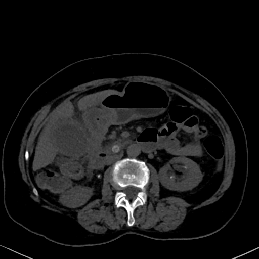 File:Cholecystitis - obstructive choledocholitiasis (CT intravenous cholangiography) (Radiopaedia 43966-47479 Axial 114).png