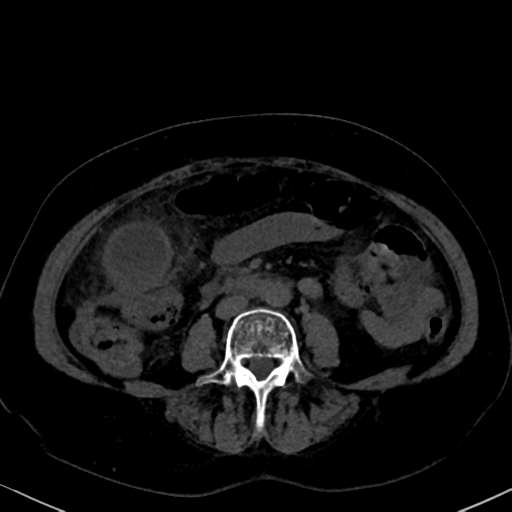 File:Cholecystitis - obstructive choledocholitiasis (CT intravenous cholangiography) (Radiopaedia 43966-47479 Axial 146).png