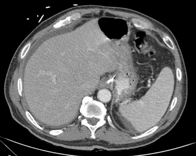 Cholecystitis - perforated gallbladder (Radiopaedia 57038-63916 A 17).jpg
