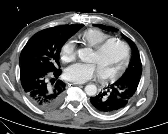 Cholecystitis - perforated gallbladder (Radiopaedia 57038-63916 A 4).jpg