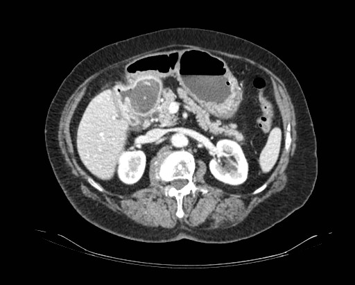 File:Cholecystoduodenal fistula (Radiopaedia 48959-54022 A 80).jpg