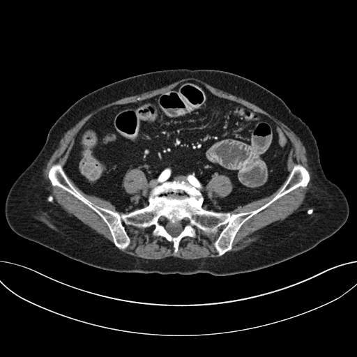 Cholecystoduodenal fistula due to calculous cholecystitis with gallstone migration (Radiopaedia 86875-103077 A 48).jpg