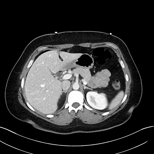 File:Choledocholithiasis after recent cholecystectomy (Radiopaedia 60929-68737 Axial 33).jpg