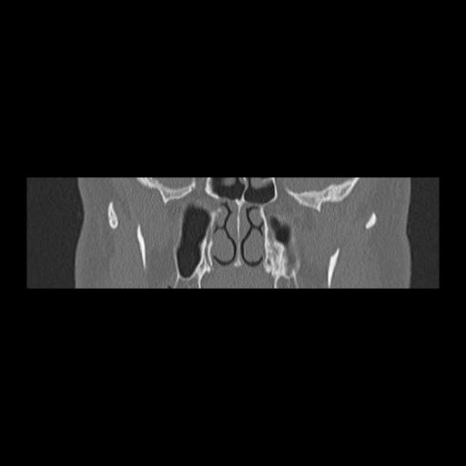 Cholesteatoma (Radiopaedia 84946-100455 Coronal bone window 60).jpg