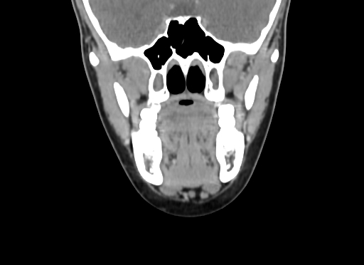 Chondroblastic osteosarcoma (Radiopaedia 67363-76741 D 49).jpg