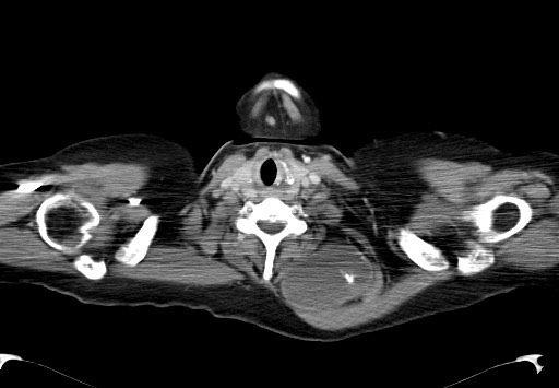 File:Chondrosarcoma - chest wall (Radiopaedia 65192-74199 C 1).jpg