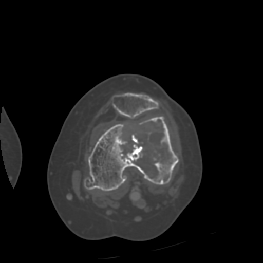 Chondrosarcoma - femur (Radiopaedia 64187-72954 Axial bone window 38).jpg