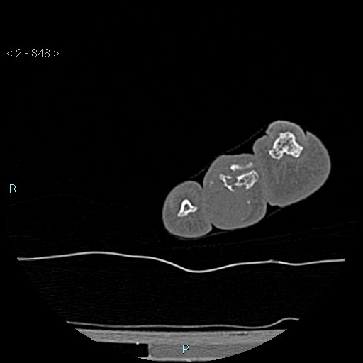 Chondrosarcoma - phalanx (Radiopaedia 69047-78812 Axial bone window 102).jpg