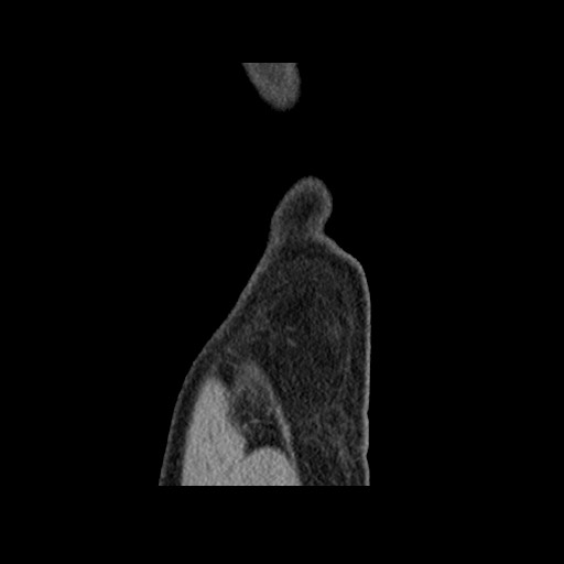 Chondrosarcoma of iliac wing (Radiopaedia 63861-72599 F 174).jpg