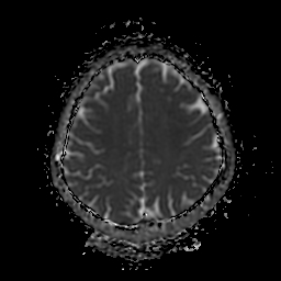 File:Chordoid glioma of third ventricle (Radiopaedia 91612-109340 Axial ADC 21).jpg