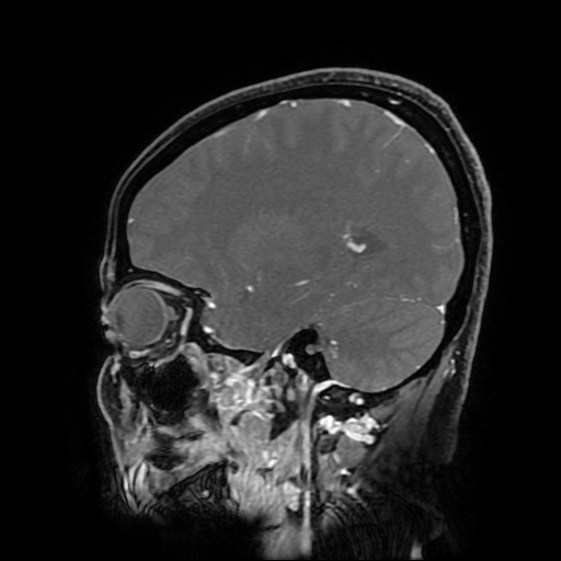 Chordoid glioma of third ventricle (Radiopaedia 91612-109340 F 142).jpg