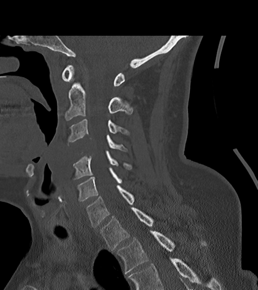 File:Chordoma (C4 vertebra) (Radiopaedia 47561-52188 Sagittal bone window 44).png
