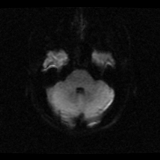 File:Choroid plexus xanthogranuloma (Radiopaedia 17650-17386 DWI 18).jpg