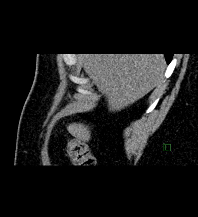 Chromophobe renal cell carcinoma (Radiopaedia 84286-99573 F 161).jpg