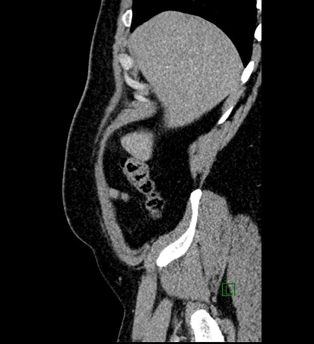 Chromophobe renal cell carcinoma (Radiopaedia 84286-99573 I 167).jpg