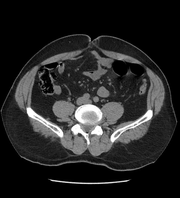 Chromophobe renal cell carcinoma (Radiopaedia 86879-103083 Axial non-contrast 77).jpg
