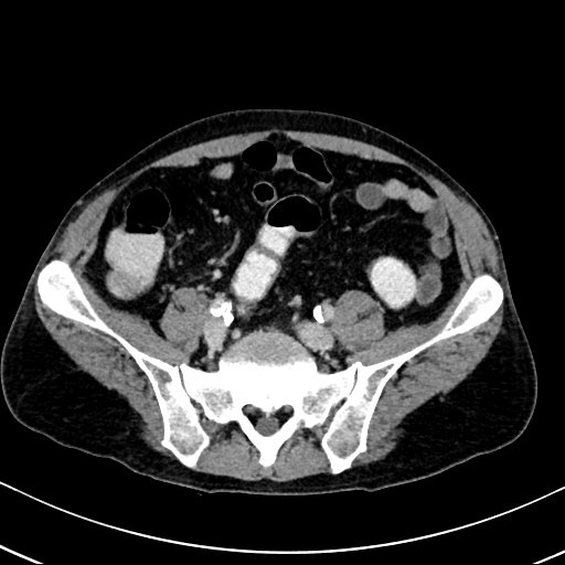 Chronic appendicitis complicated by appendicular abscess, pylephlebitis and liver abscess (Radiopaedia 54483-60700 B 107).jpg