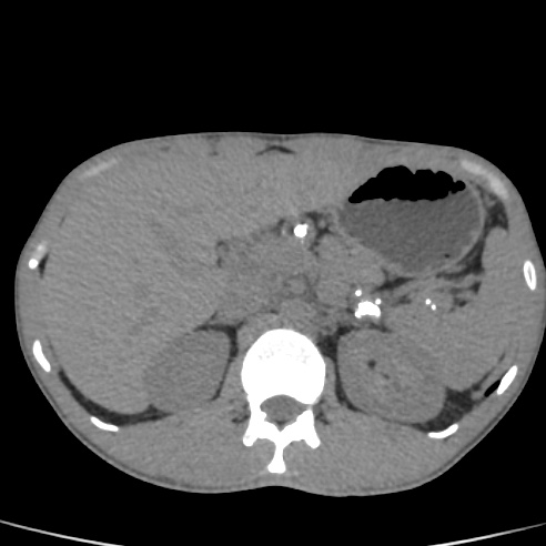File:Chronic calcific pancreatitis (Radiopaedia 56280-62953 Axial non-contrast 11).jpg