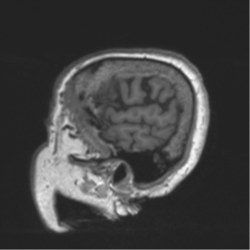 Chronic hypertensive encephalopathy (Radiopaedia 39993-42482 Sagittal T1 80).png