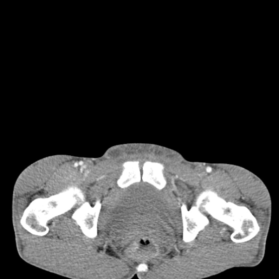 Chronic large bowel pseudo-obstruction (Radiopaedia 43181-46492 A 161).jpg