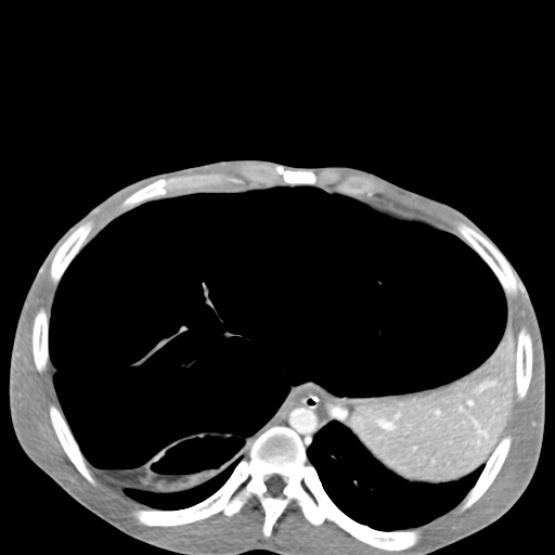 Chronic large bowel pseudo-obstruction (Radiopaedia 43181-46492 A 39).jpg