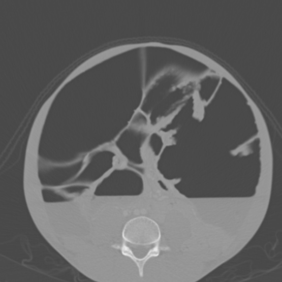 Chronic large bowel pseudo-obstruction (Radiopaedia 43181-46492 Axial bone window 112).jpg