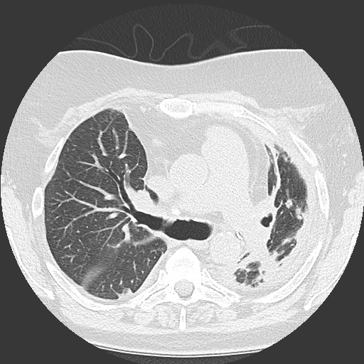 Chronic lung allograft dysfunction - restrictive form (Radiopaedia 60595-68316 Axial lung window 27).jpg