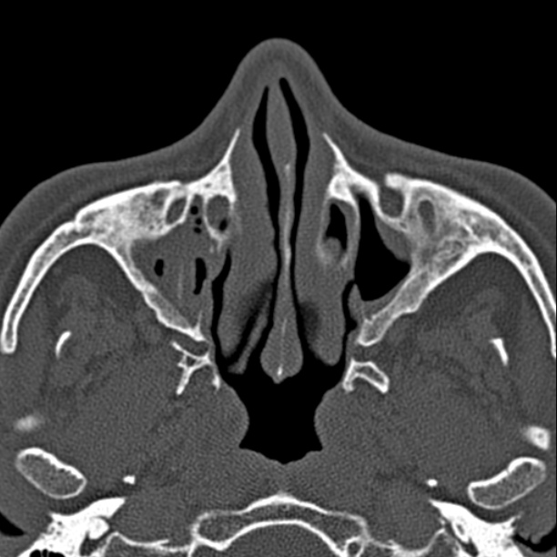Chronic maxillary sinusitis (Radiopaedia 27879-28116 Axial bone window 18).jpg