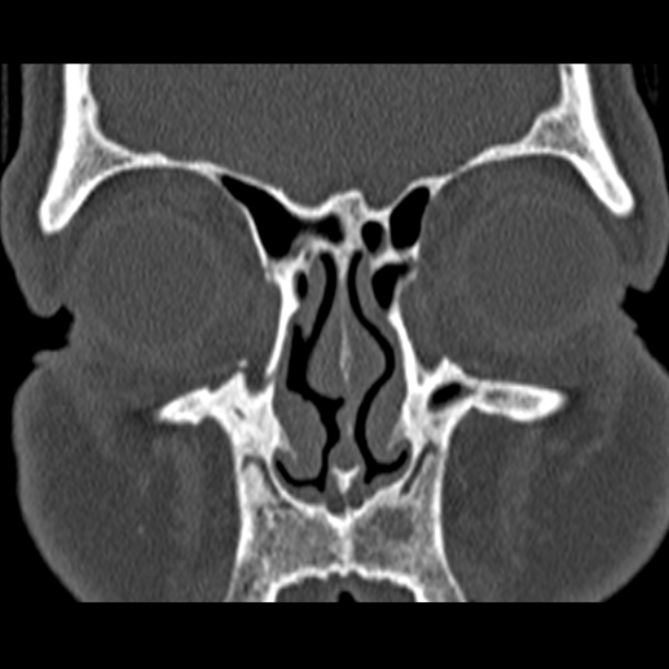 Chronic maxillary sinusitis (Radiopaedia 27879-28116 Coronal bone window 14).jpg