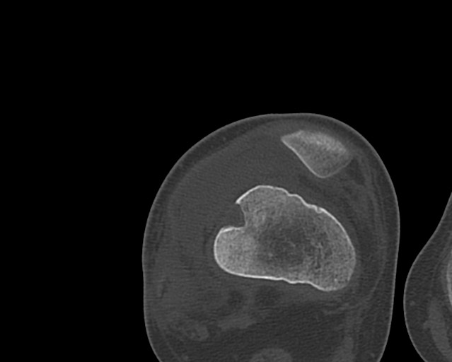 Chronic ostemyelitis of the femur with long sinus tract (Radiopaedia 74947-85982 Axial bone window 204).jpg