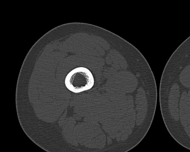 Chronic ostemyelitis of the femur with long sinus tract (Radiopaedia 74947-85982 Axial bone window 70).jpg