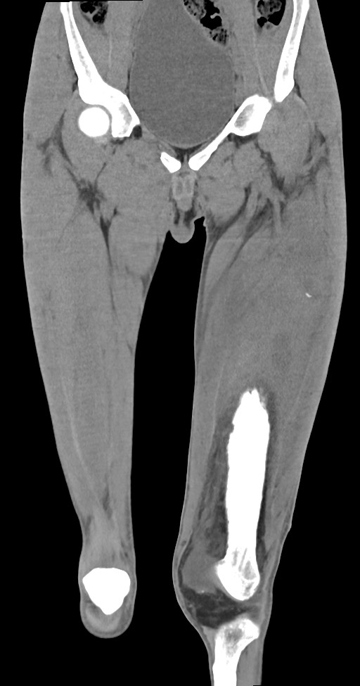 Chronic osteomyelitis (with sequestrum) (Radiopaedia 74813-85822 E 18).jpg
