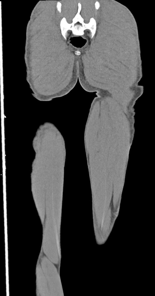 Chronic osteomyelitis (with sequestrum) (Radiopaedia 74813-85822 E 51).jpg