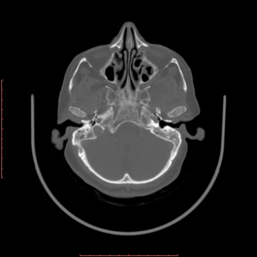Chronic osteomyelitis - maxilla (Radiopaedia 23783-23927 Axial bone window 118).jpg