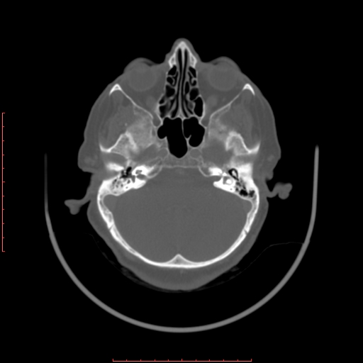 Chronic osteomyelitis - maxilla (Radiopaedia 23783-23927 Axial bone window 124).jpg