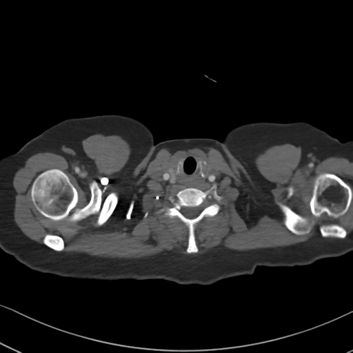 Chronic pulmonary embolus (Radiopaedia 39129-41341 Axial C+ CTPA 2).png