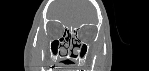 Chronic sphenoidal sinusitis (Radiopaedia 62030-70122 Coronal bone window 63).jpg