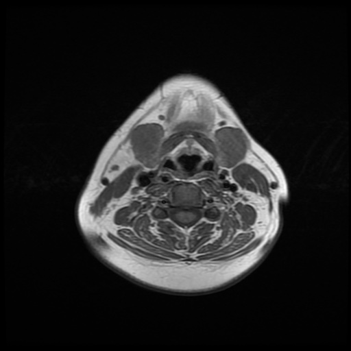 File:Chronic submandibular sialadenitis (Radiopaedia 61852-69885 Axial T1 18).jpg
